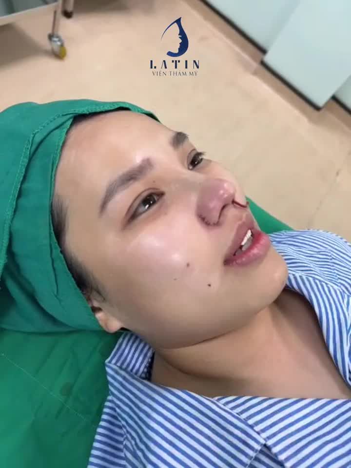 Mũi bán cấu trúc phom tự nhiên theo yêu cầu cho chị khách hàng