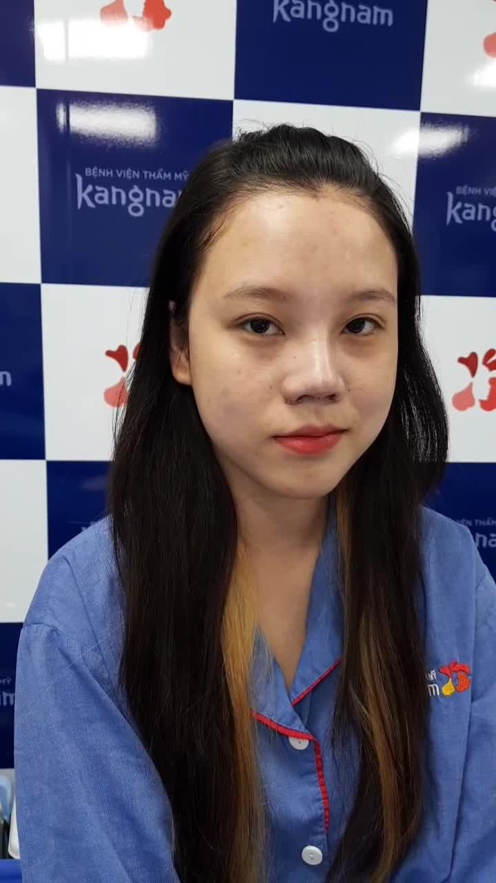 Khách hàng nâng mũi Sline 4D kết hợp cắt cánh mũi