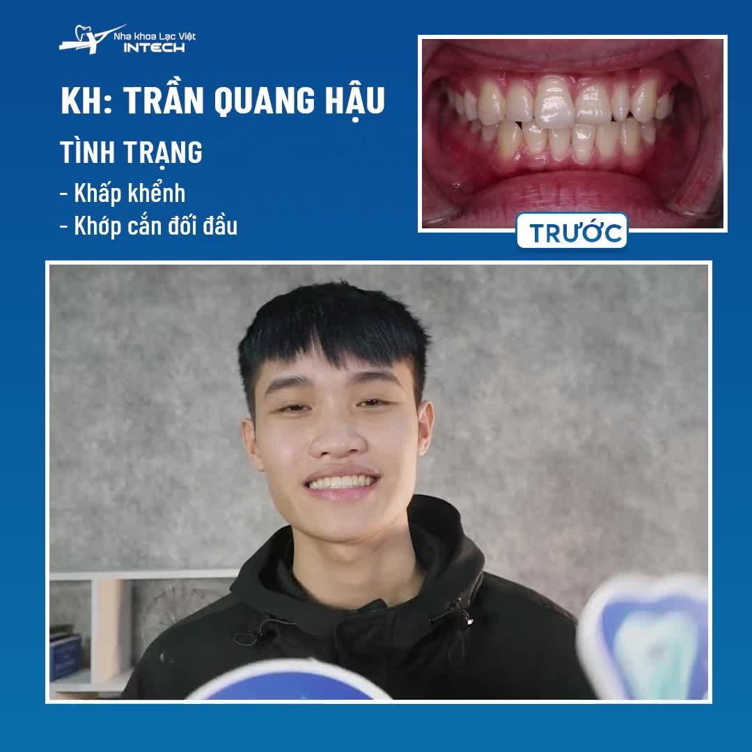 NIỀNG RĂNG KHẤP KHỂNH, KHỚP CẮN ĐỐI ĐẦU SAU 15 THÁNG