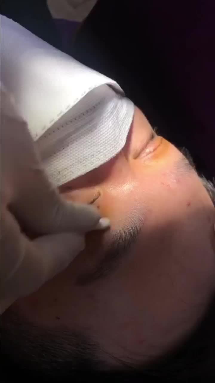 Cắt chỉ sau 7 ngày của Dr.Hải Lê, nếp mí đã hoàn thiện và tạo khuôn mí đẹp.