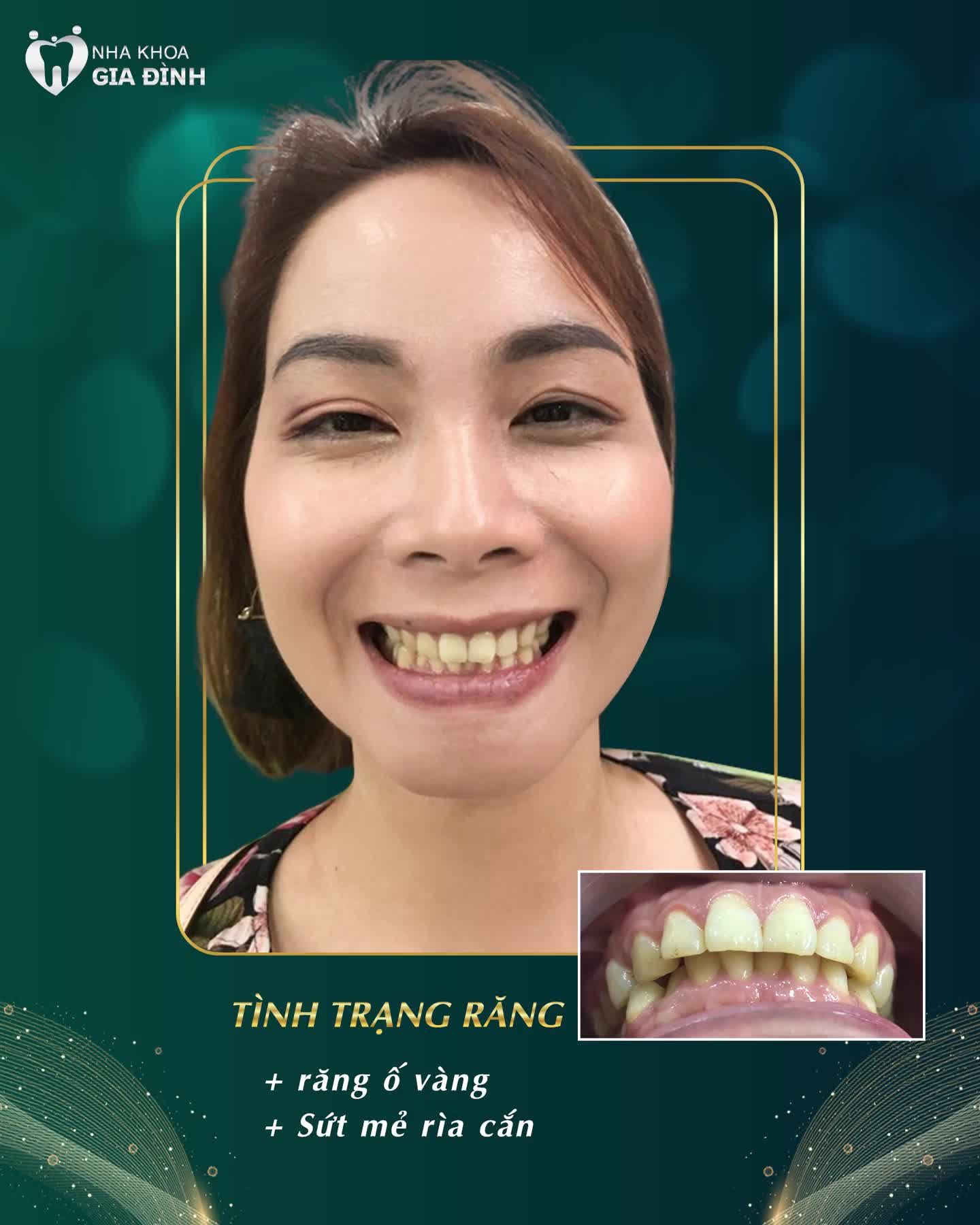 NỤ CƯỜI CỦA KHÁCH HÀNG LÀ MỘT KIỆT TÁC ĐƯỢC THIẾT KẾ BỞI BÁC SĨ GIÀU KINH NGHIỆM TẠI NHA KHOA GIA ĐÌNH
