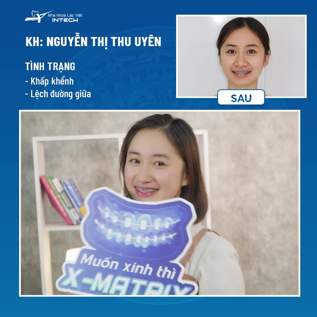 “…RĂNG ĐỀU ĐẸP, KHUÔN MẶT KHÔNG CÒN TRÒN NỮA…”
