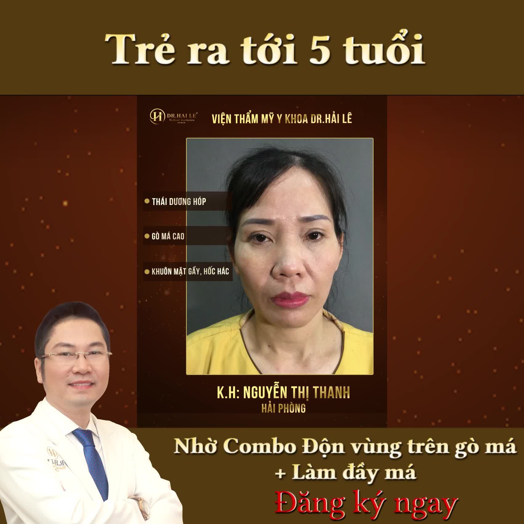 Thái dương lõm, má hóp ... sẽ không còn chỉ với combo làm đầy vùng trên gò má và làm đầy má tại Dr.Hải Lê.