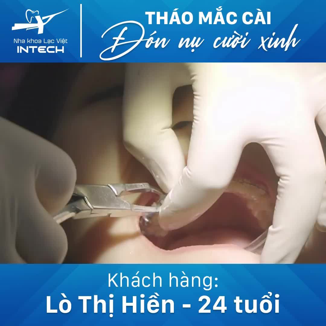 THÁO MẮC CÀI – ĐÓN NỤ CƯỜI XINH