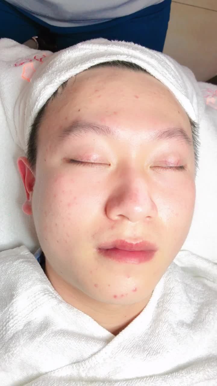 Trị mụn công nghệ De-acne Kangnam - Kết quả cực bất ngờ sau 6 buổi điều trị