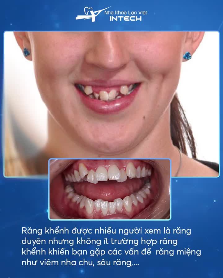 NIỀNG RĂNG KHỂNH NHỔ RĂNG NHƯ THẾ NÀO NHỮNG TRƯỜNG HỢP NÀO CẦN NHỔ RĂNG