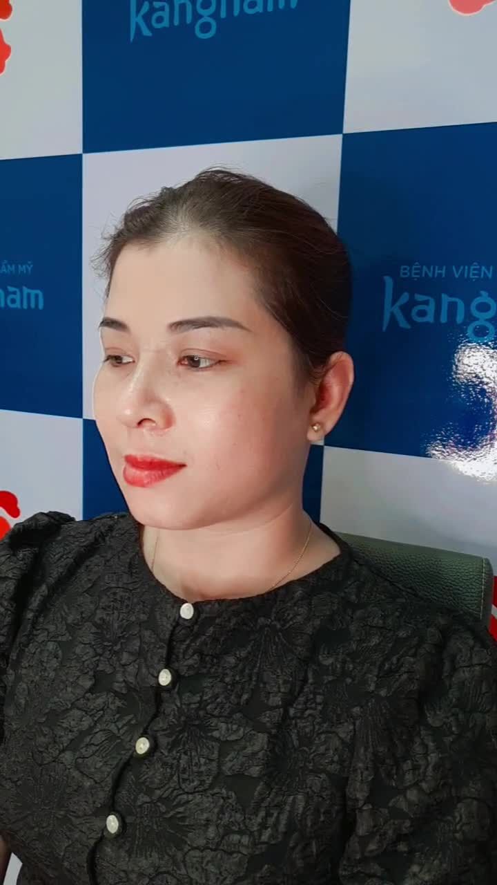 Nâng mũi cao sang với dịch vụ cấu trúc tại Kangnam sài Gòn