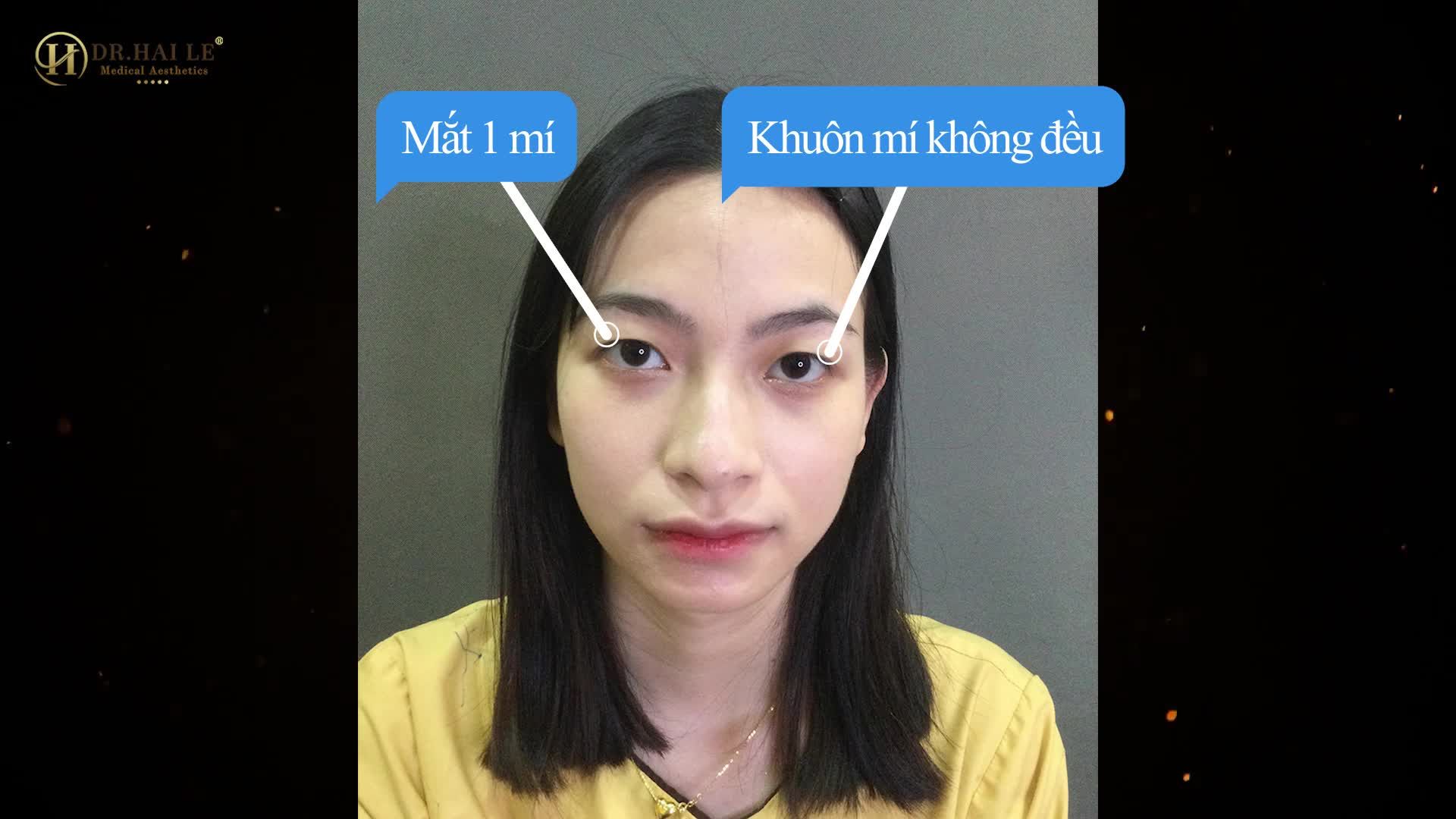 Khách hàng chia sẻ điều gì sau khi trải nghiệm dịch vụ cắt mí tại Dr.Hải Lê.