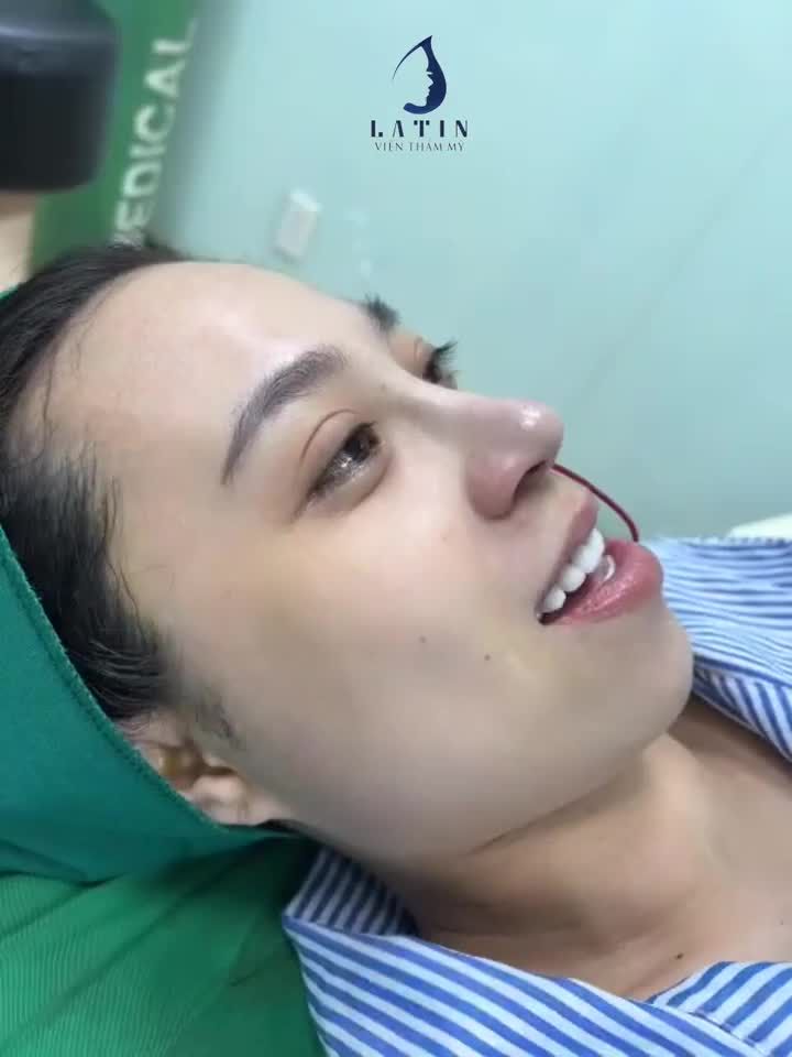 Mũi bán cấu trúc sửa lại kết hợp thu đầu mũi, lót megaderm, cấy mỡ trung bì mũi