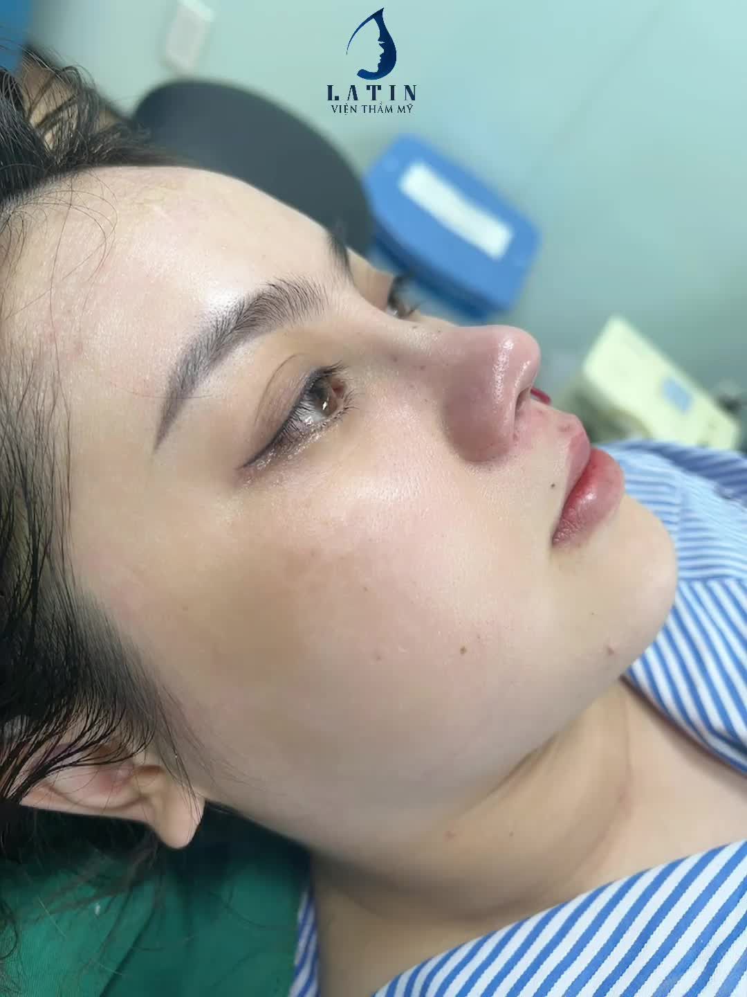 Mũi bán cấu trúc thay đổi gương mặt cho chị gái