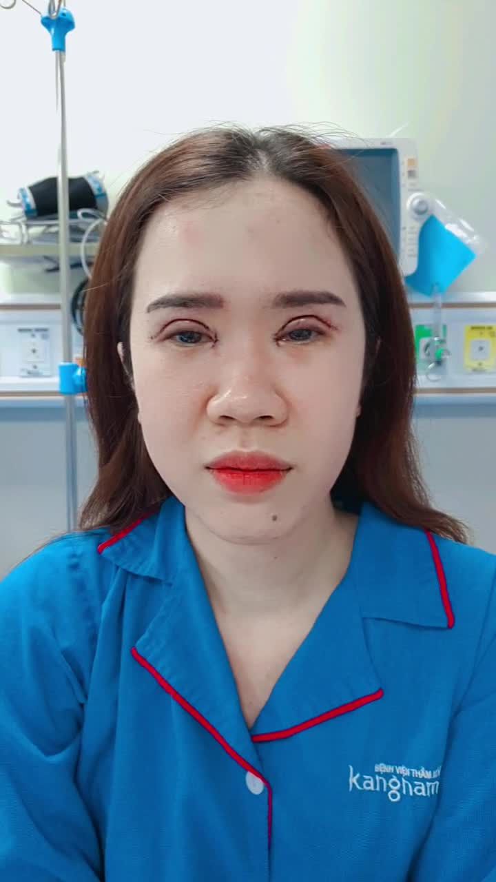 Nữ KH thực hiện ngay combo[Cắt mí trên Plasma + Tạo khóe mắt trong] và đây là kết quả!
