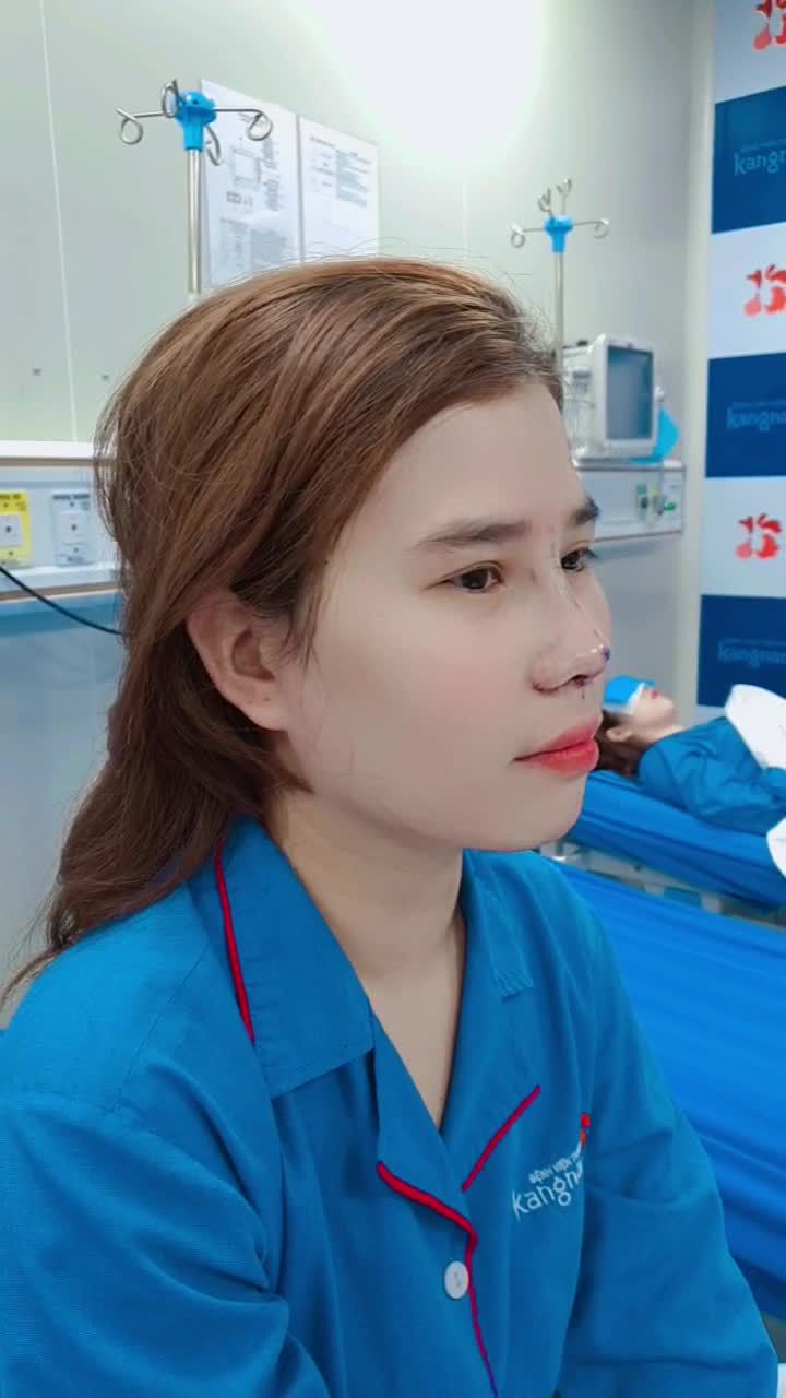 Khách hàng thay đổi ngoạn mục sau khi Nâng mũi Pureform + chỉnh xương + cắt cánh mũi