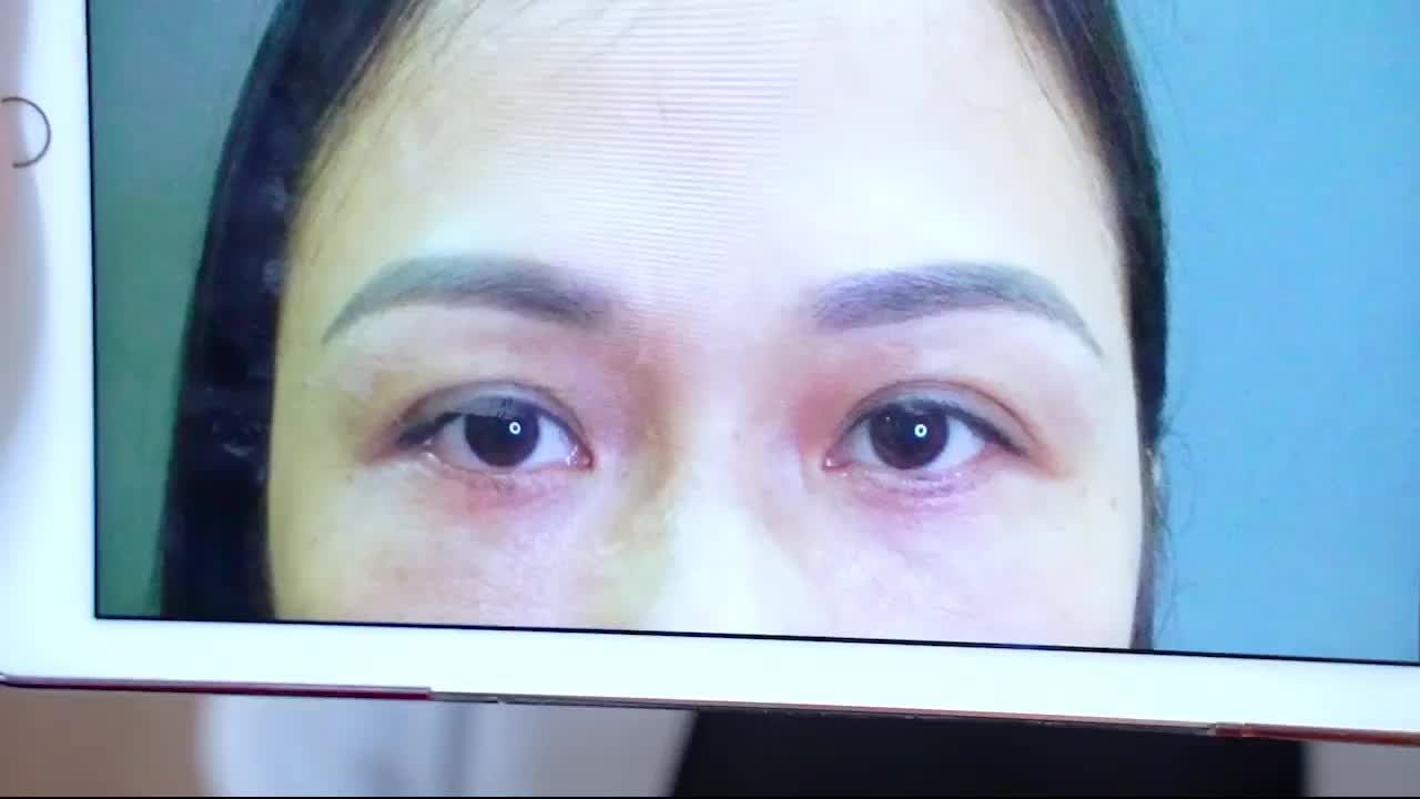 Ngắm nhìn kết quả nếp mí dưới sau 7 ngày cắt chỉ của chị khách hàng dưới đây để cùng thấy được sự thây đổi của khách hàng
