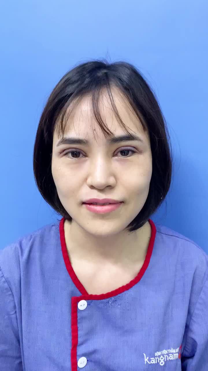 Siêu lột xác với combo phẫu thuật cắt mí - tạo ginhf môi tim tại BVTM KANGNAM