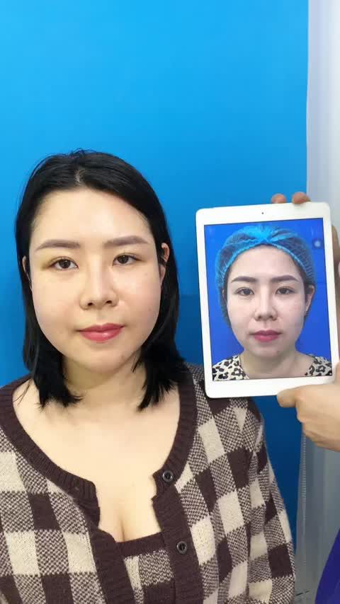 Tái khám cấy mỡ mặt BioGen sau 10 ngày