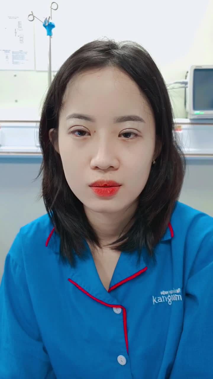 KH vừa cắt mí xong, không hề sưng tím, xinh ngay sau khi cắt