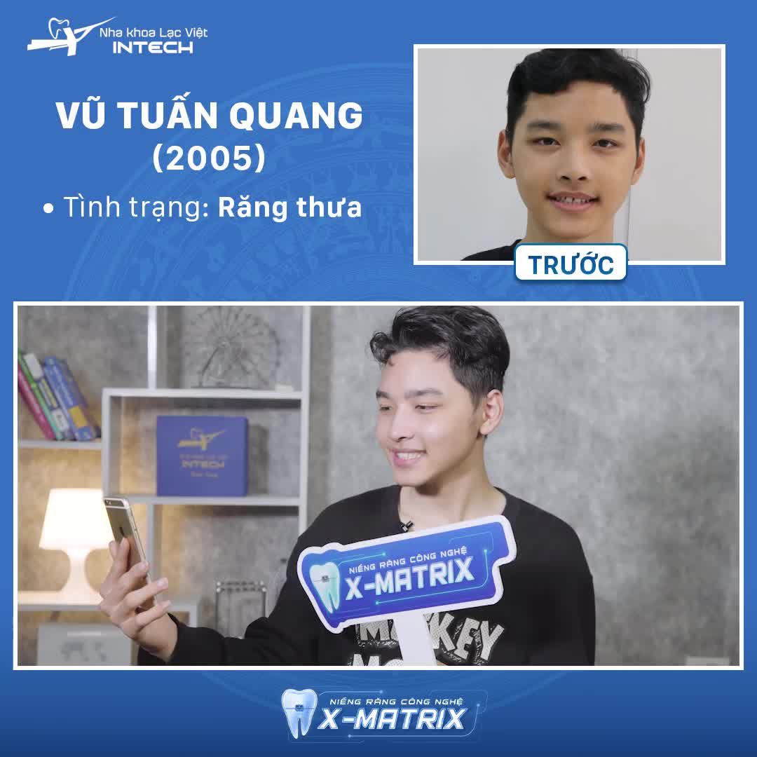 KHẮC PHỤC RĂNG THƯA NHỜ NIỀNG RĂNG CÔNG NGHỆ X-MATRIX