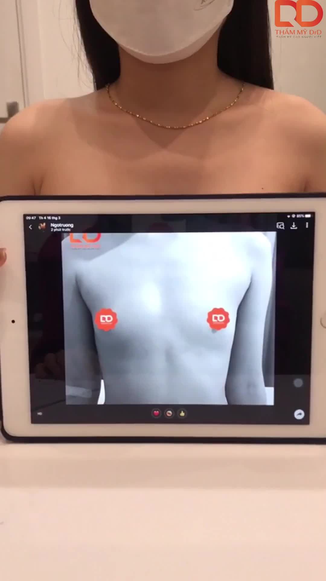 Ngực hầu như không có tuyến vú và da thừa thì nên đặt túi gì và size ngực bao nhiêu là hợp lý