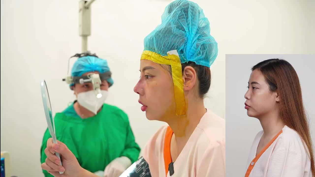 Tạo hình dáng mũi Sline cao cho khách hàng từng tiêm filler