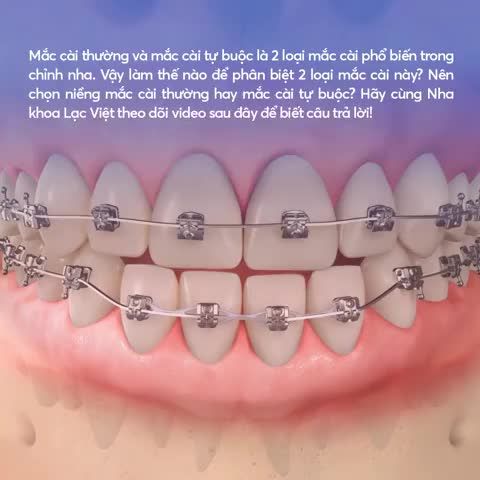 Mắc cài thường và mắc cài tự buộc là 2 loại mắc cài phổ biến trong chỉnh nha.