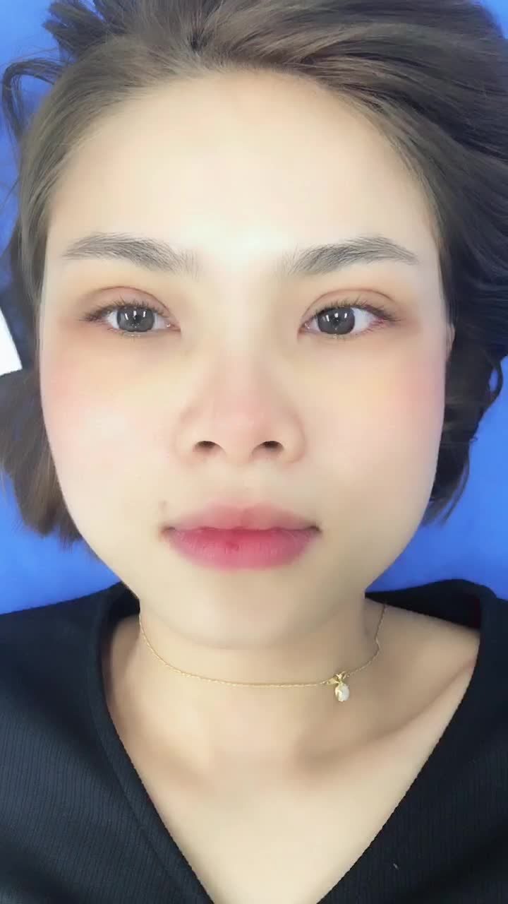 5 ngày sau cắt mí - Đường mí đẹp như vẽ!