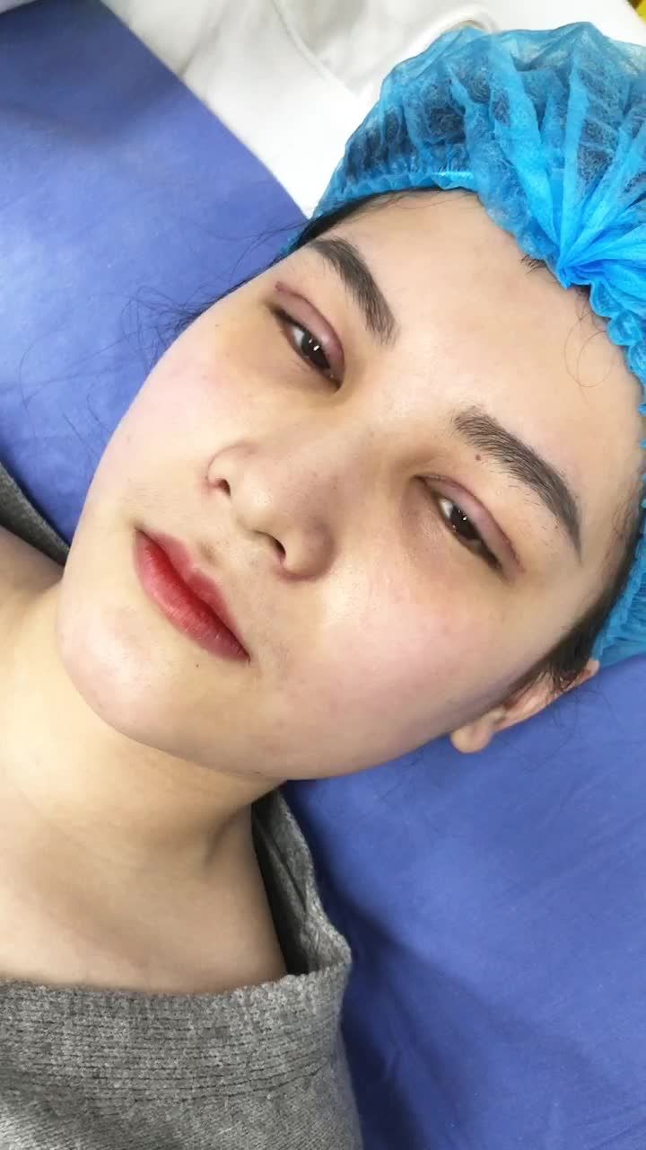 Cắt mí trên Plasma 6 ngày đẹp tự nhiên