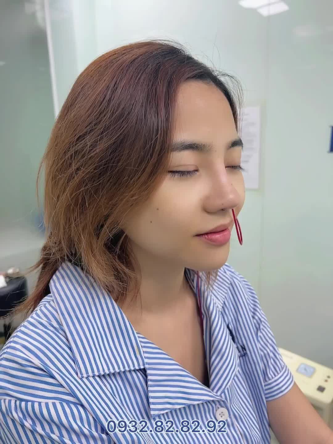 Sửa lại dáng mũi CỨU cả gương mặt