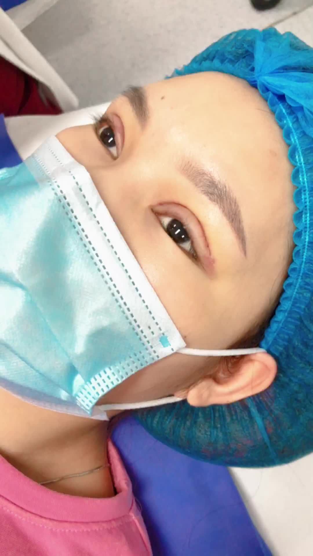 Nếp mí đẹp tự nhiên sau 5 ngày phẫu thuật cắt mí trên Plasma tại Kangnam