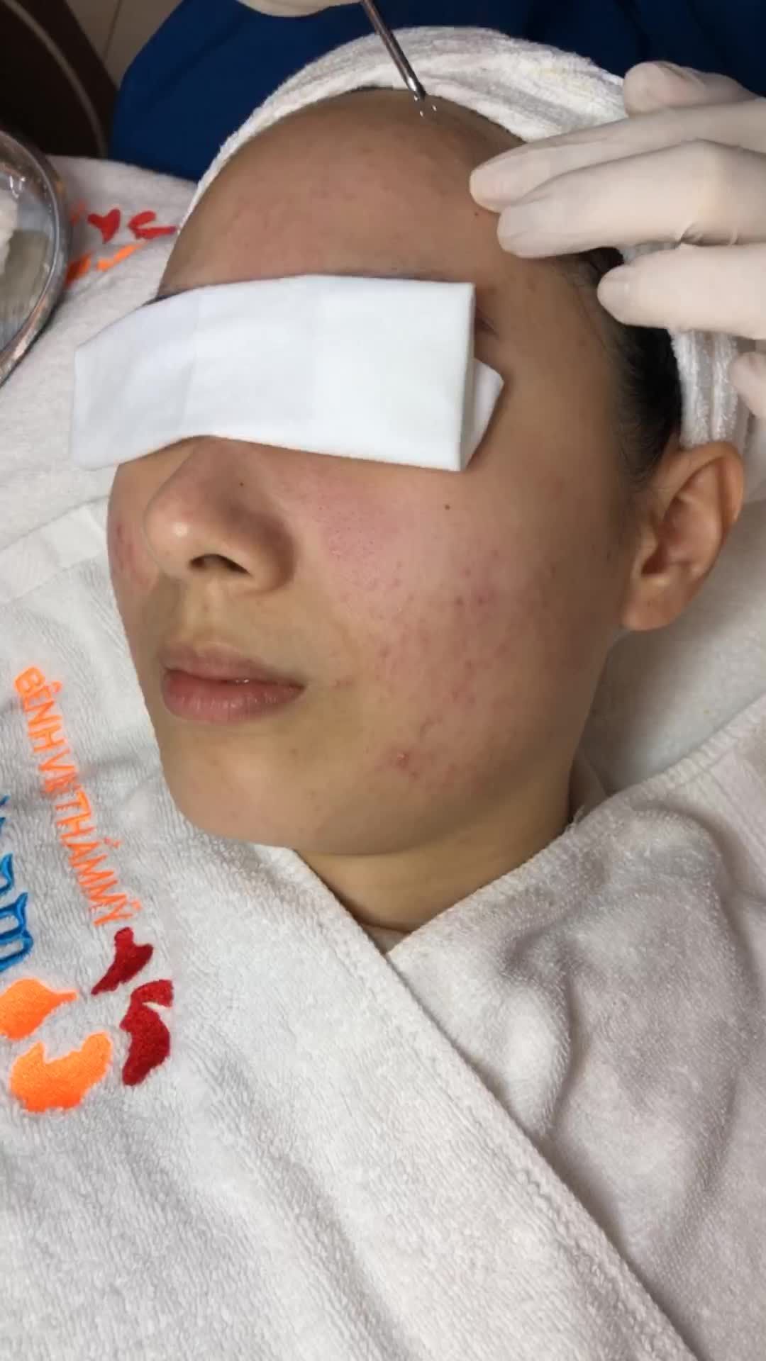 Những điều lưu ý trong quá trình điều trị mụn tại Kangnam - cùng theo dõi livestream để hiểu rõ về điều trị mụn