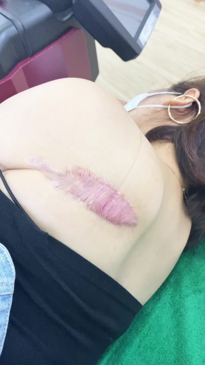Điều trị sẹo lồi bằng phương pháp tiêm