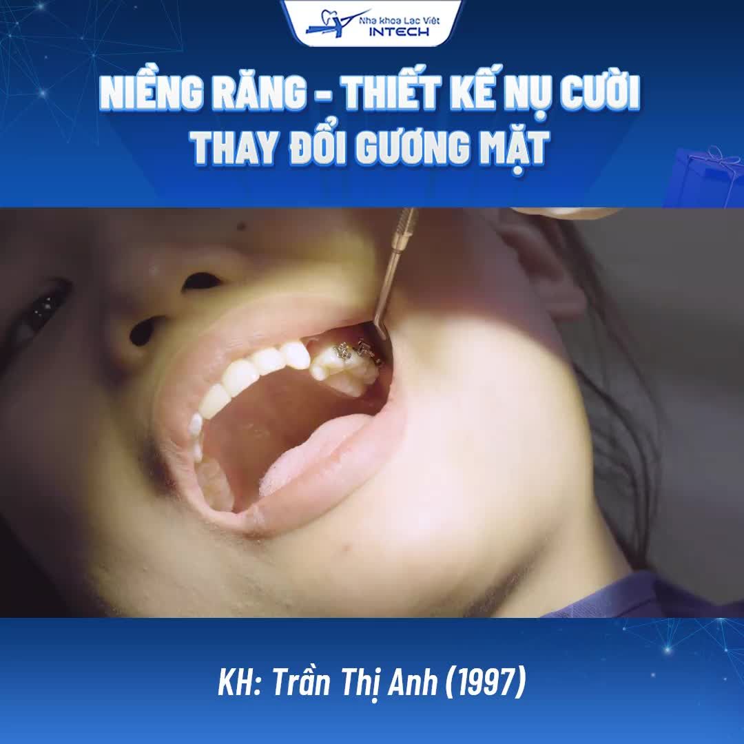 CẬN CẢNH QUÁ TRÌNH GẮN MẮC CÀI KIM LOẠI TỰ BUỘC