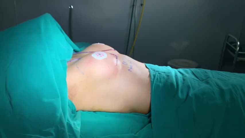 KẾT THÚC NGÀY LÀM VIỆC CỦA EKIP DR. MINH PHAM VỚI CA NÂNG CẤP V1