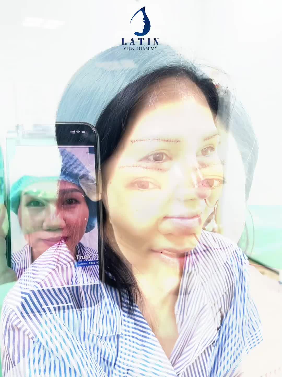 Combo 3 dịch vụ xinh đẹp  Nâng mũi sửa lại - Độn thái dương - Nâng cung mày đa tầng