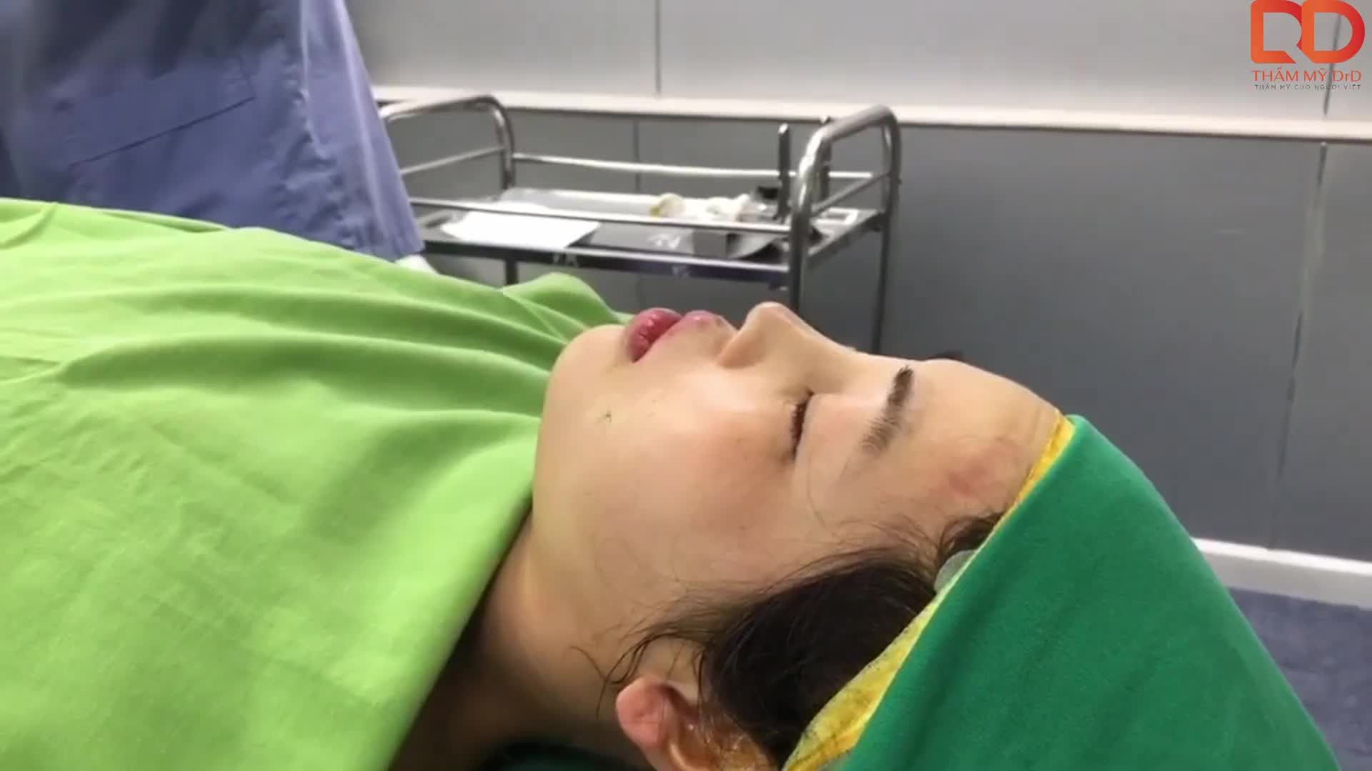 Đã có kết quả  ca nâng mũi cấu trúc + độn cằm+ cấy mỡ má rồi cả nhà ơi.