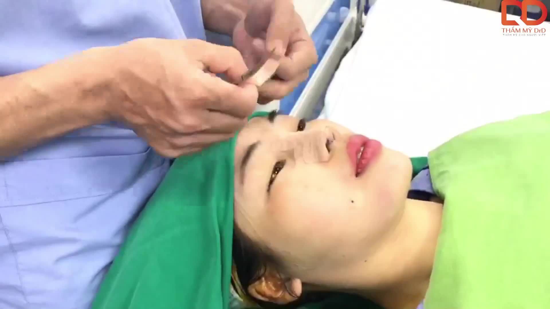 Sau khi kết thúc ca phẫu thuật khách hàng sẽ được băng cố định, để mũi, cằm nhanh ổn định, về phom dáng.