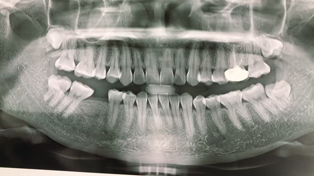 ca cấy ghép chân răng nhân tạo implant vị trí số 46 cho khách hàng