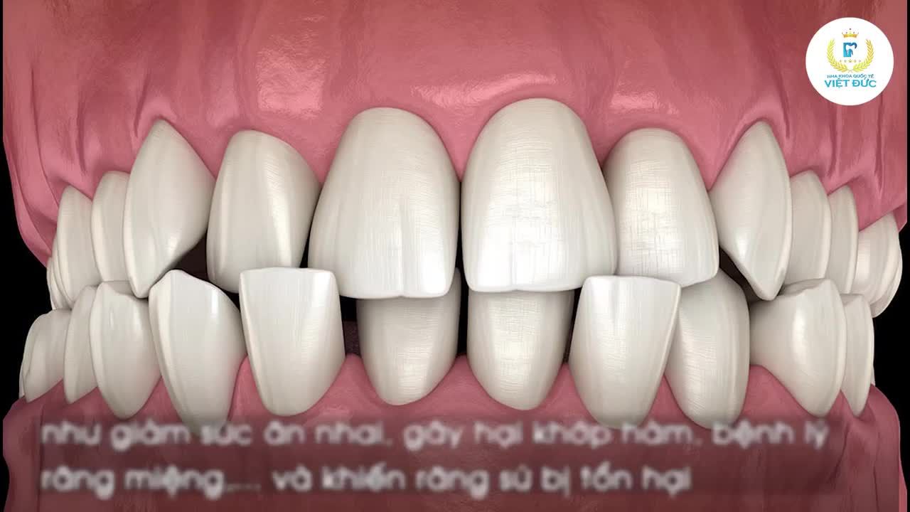 CHỈNH KHỚP CẮN - BỌC RĂNG SỨ