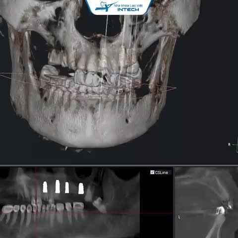 MẤT RĂNG KHIẾN TÔI MẤT TỰ TIN KHI GIAO TIẾP...