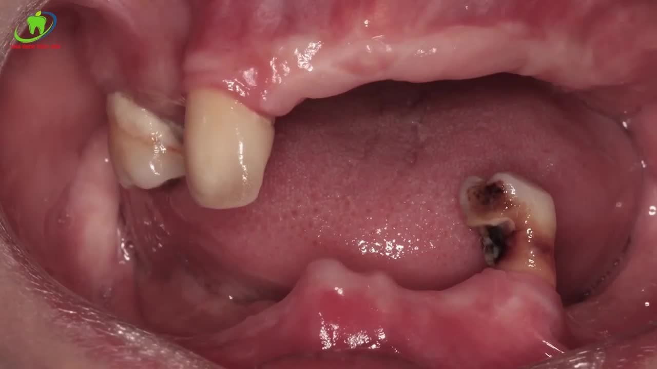 MẤT RĂNG VÀ PHẢI ĐEO HÀM THÁO LẮP SUỐT ĐỜI...