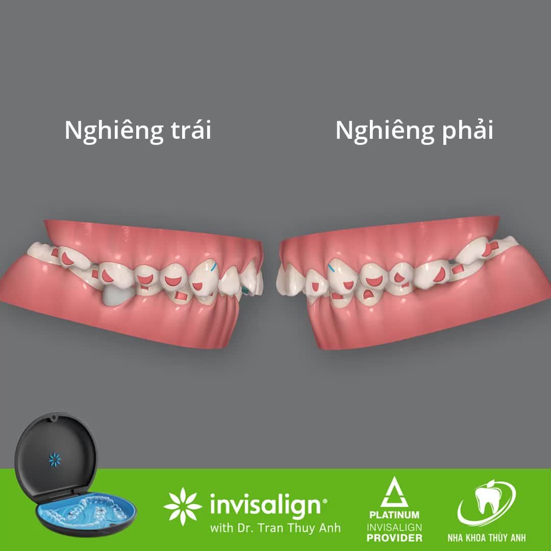 MÔ PHỎNG KẾT QUẢ ĐIỀU TRỊ RĂNG HÔ KHẤP KHỂNH VỚI INVISALIGN