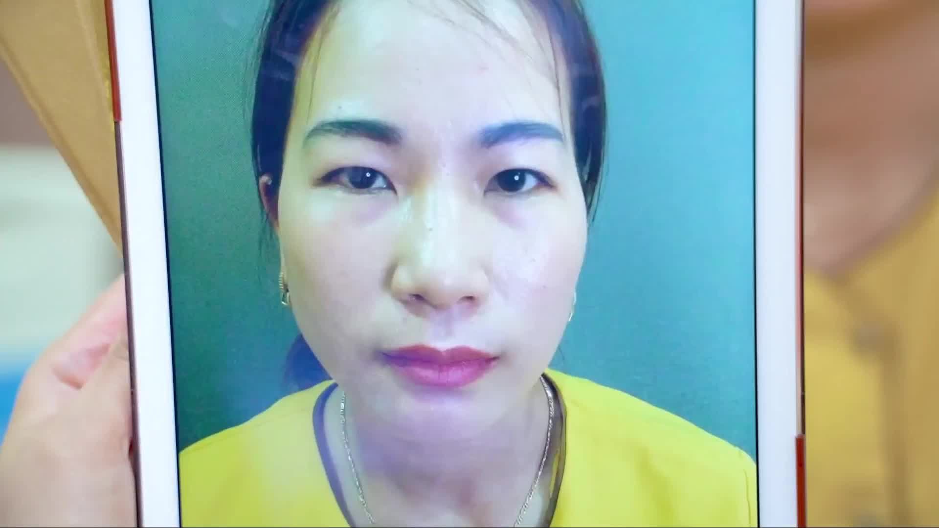 PHÉP MÀU CHO CHỊ KHÁCH HÀNG SỞ HỮU ĐÔI MẮT U BUỒN SAU KHI CẮT MÍ TẠI DR.HẢI LÊ