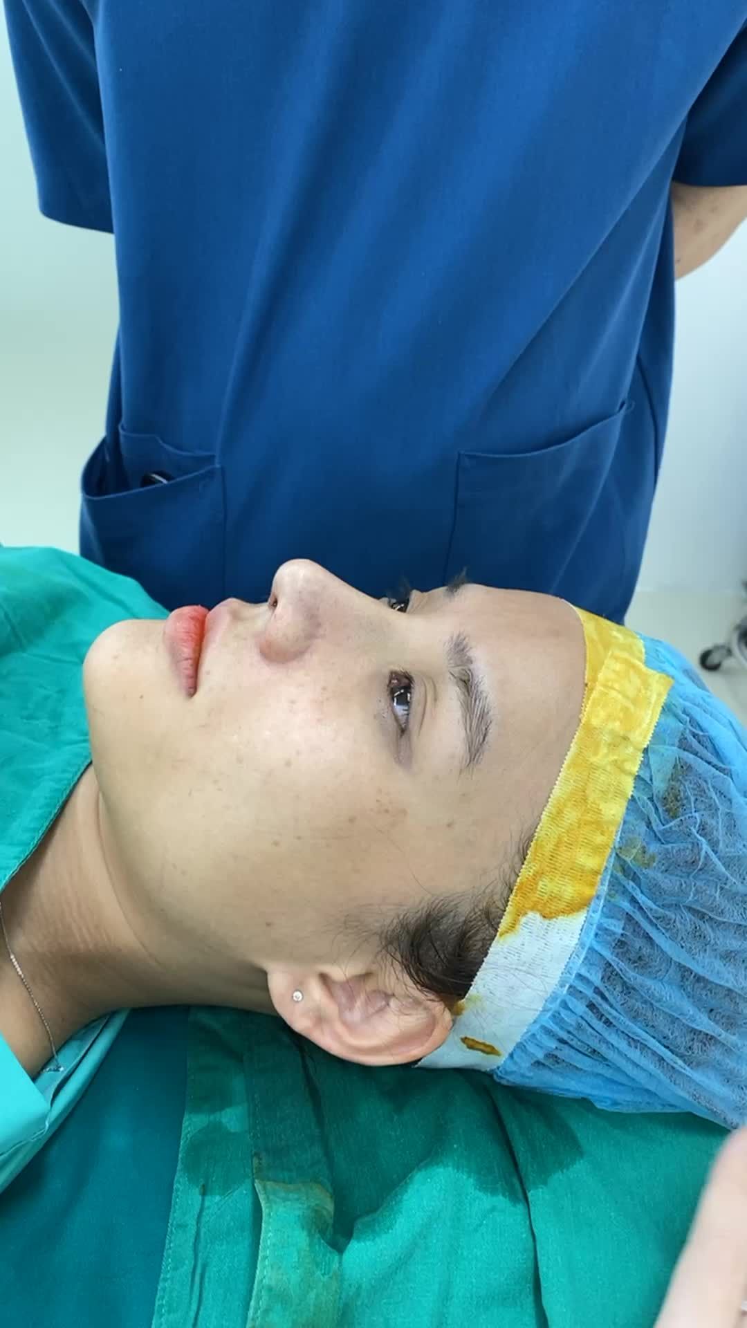 Tạo hình dáng mũi chuẩn tỉ lệ vàng với phương pháp nâng mũi cấu trúc Surgiform.