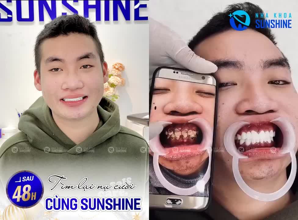 TẬP CƯỜI Ở TUỔI 18, thật khó để tin Nhưng điều đó đã xảy ra tại Nha khoa Sunshine.