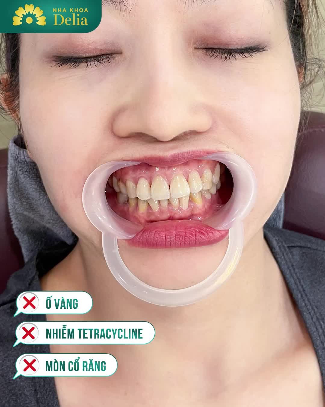 Khách hàng Bích Huệ quay lại tái khám, sau hơn 1 năm thẩm mỹ răng sứ