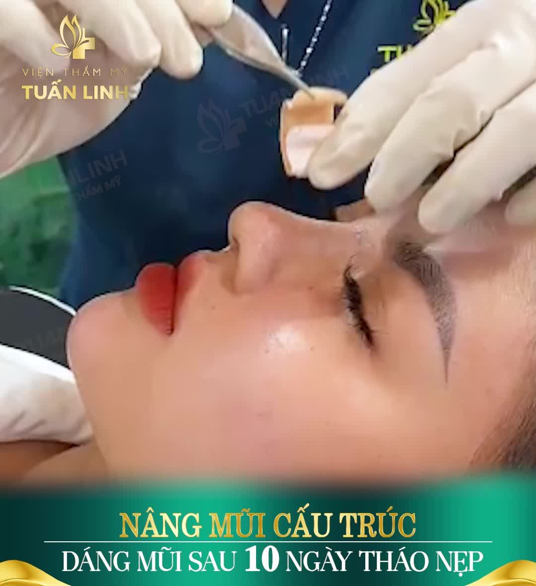 Xem dáng mũi sau khi tháo nẹp - Khoảnh khắc ''siêu hồi hộp'' mà bất kì ai cũng nên trải qua.
