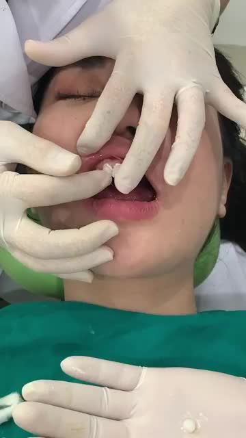 QUÁ TRÌNH THẨM MỸ 18 RĂNG SỨ CAO CẤP CHO KHÁCH HÀNG