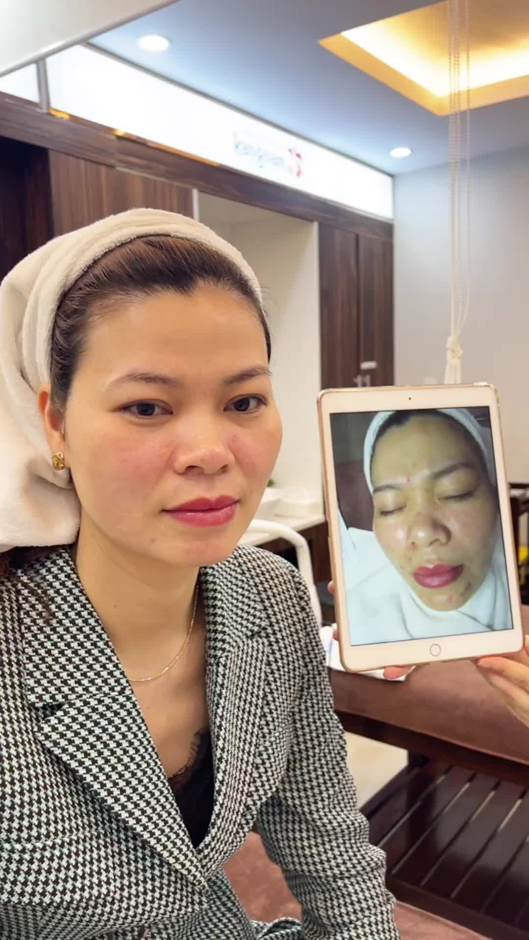 Chưa từng có! DỨT ĐIỂM MỤN chỉ từ 190kkk