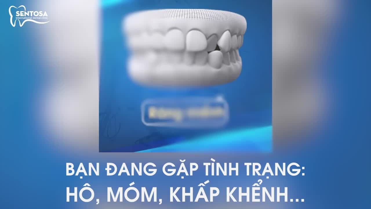 INVISALIGN NIỀNG RĂNG VÔ HÌNH - NHẬN ƯU ĐÃI LINH ĐÌNH Chỉ có tại SENTOSA
