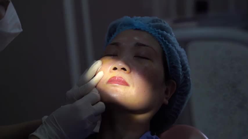 Xóa rãnh mũi má già nua chỉ trong một nốt nhạc không cần phẫu thuật
