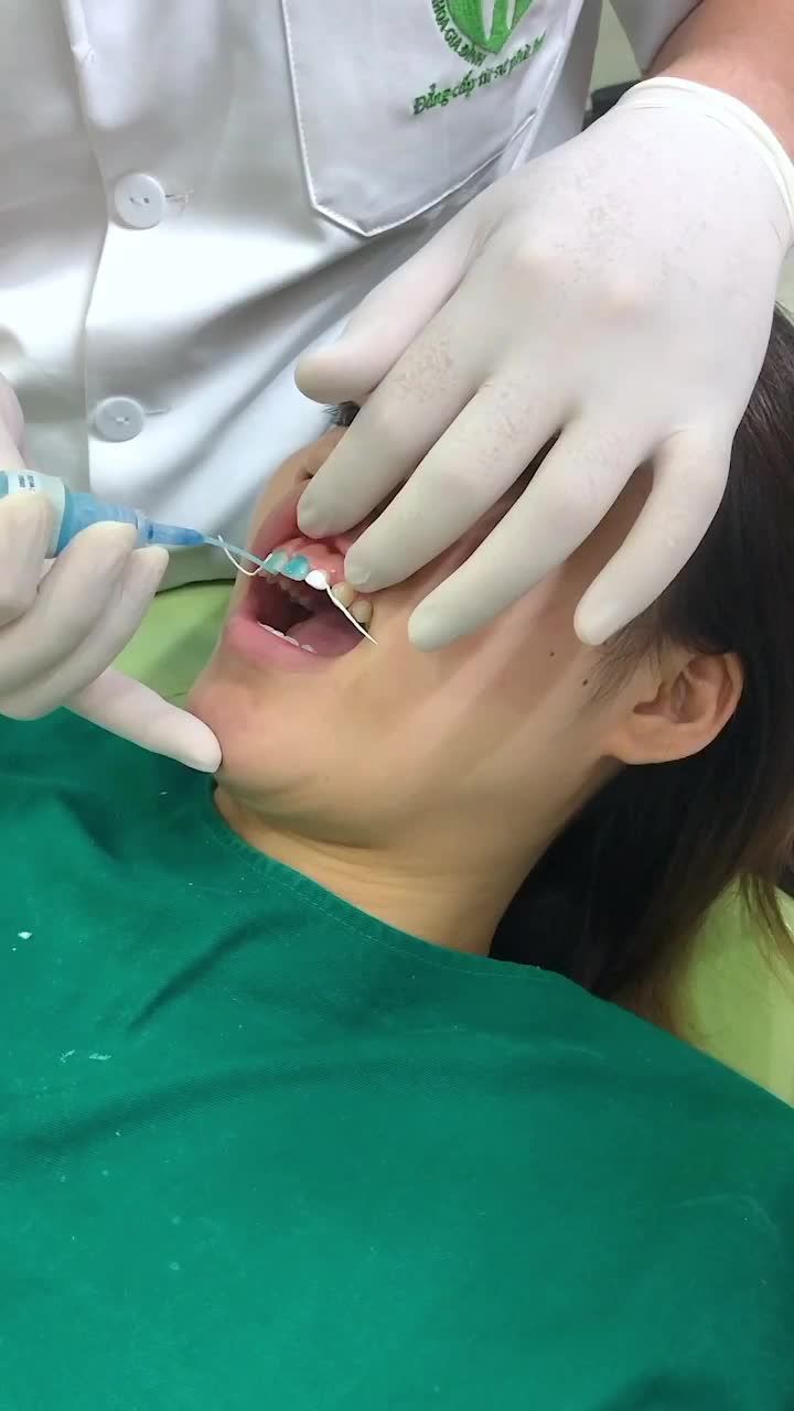 DÁN VENEER SỨ KHÔNG CẦN MÀI RĂNG CHO MỘT NỮ KHÁCH HÀNG